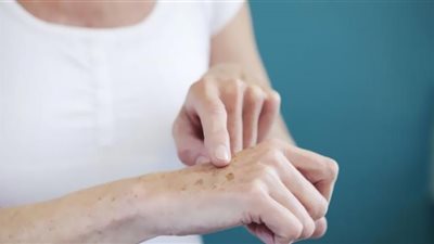 علامات خطيرة على الجلد تؤكد إصابتك بمرض السكري من النوع 2