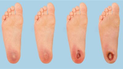 أعراض الإصابة بالقدم السكري ومضاعفاته