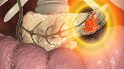 خبراء يحذرون: التدخين يرفع خطر الإصابة بسرطان البنكرياس مرتين