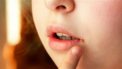 احذر.. حالة شائعة تصيب الشفاه تزيد من خطر الإصابة بسرطان الجلد