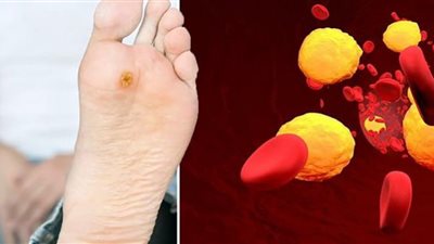 ارتفاع نسبة الكوليسترول.. مشاكل القدم التي تدل على ذلك