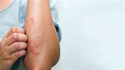 اكتشاف عرض مخيف وغير متوقع لسرطان الدم يظهر على الجلد