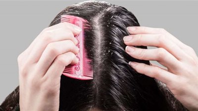 وصفة جل الصبار للقضاء على القشرة