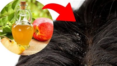لعلاج القشرة.. طريقة تنظيف فروة الرأس بخل التفاح