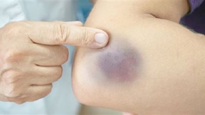 بعلامات بسيطة.. كيف تفرق بين الكدمات والجلطات الدموية