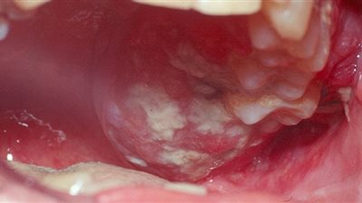 ما هي مسببات سرطان الفم؟