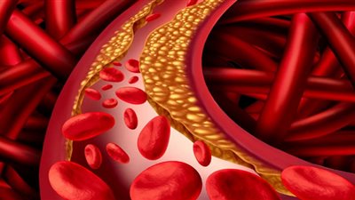 ما الذي يساعد على خفض نسبة الكوليسترول دون دواء ؟