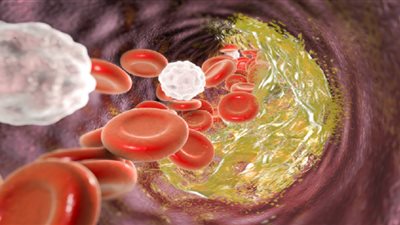 دراسة: الكوليسترول الجيد يقلل من خطر الإصابة بمرض الزهايمر