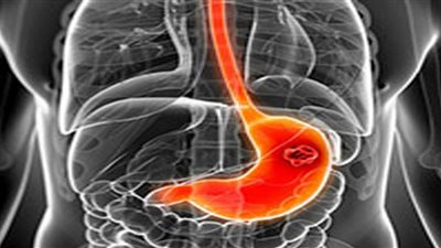 منها الحموضة والغثيان.. 10 أعراض لسرطان المعدة