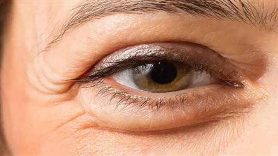 علاج بسيط لانتفاخ العيون.. واحذر هذه الأعراض