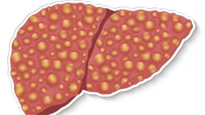 علامة في الفم تدل على إصابتك بمرض الكبد الدهني غير الكحولي