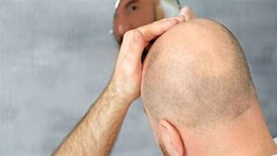 طبيبة روسية تكشف لماذا فيروس كورونا يقتل الرجال الصُلع