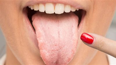 ما هي علاقة التهاب اللسان بالأمراض الأخرى