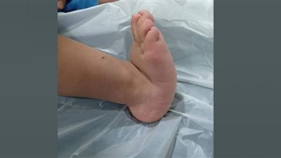 تقويم وتصليح الكاحل الخلقي العمودي لطفل يبلغ من العمر عامًا بالبحيرة