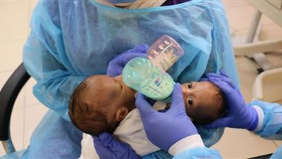 صور.. أول توأم ملتصق في العالم يحصلان على وظيفة في مجال الكهرباء