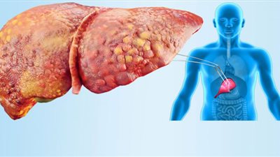 4 علامات تدل على أن لديك مرحلة مبكرة من مرض الكبد الدهني