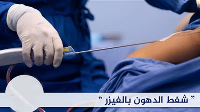 قبل وبعد شفط الدهون بالفيزر وأهم المميزات والعيوب