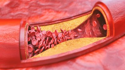 كيف تقلل من خطر الإصابة بتصلب الشرايين ؟