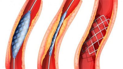 دراسة: بداية من سن الـ 40 تزداد حالات الإصابة بتصلب الشرايين