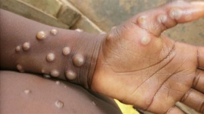 أول دولة تعلن تطبيق الحجر الصحي الإجباري لمرضى جدري القردة 21 يومًا
