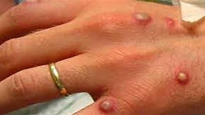 (فيديو) تعرف على أعراض الإصابة بجدري القرود