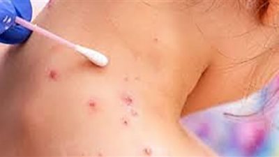 (فيديو) باحث بالمملكة المتحدة: توافر لقاح للتطعيم ضد جدري القرود بجرعتين بينهما 28 يومًا