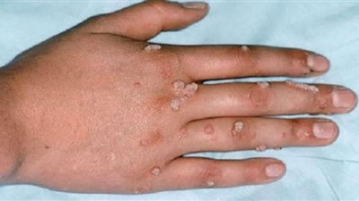 البرتغال تسجل 14 إصابة مؤكدة جديدة بجدري القرود