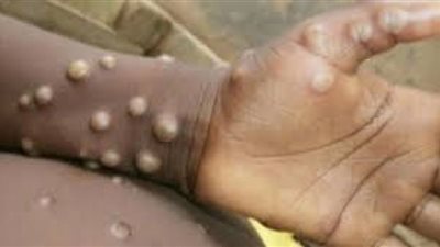 هل ينتشر جدري القرود كفيروس كورونا؟ .. أستاذ مناعة يجيب (فيديو)