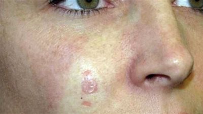 الصحة تكشف أعراض أكثر نوع سرطان يمكن علاجه بسهولة