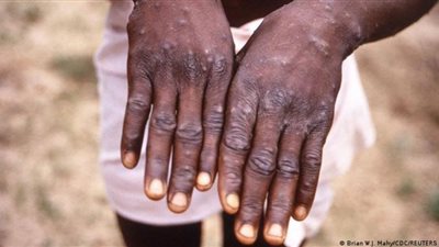 جدري القرود يغزو العالم وسط حالة من الهلع