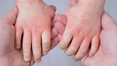 إنفلونزا الطماطم تنتشر في ولايات الهند.. اكتشاف 26 حالة