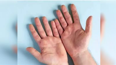 إنفلونزا الطماطم أحدث صيحات الفيروسات.. معلومات عن المرض وأعراضه