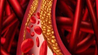 ألم في 3 مناطق بالجسم تشير لارتفاع الكولسترول في الدم