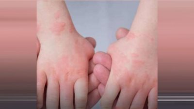 ‏ إنفلونزا الطماطم تصيب الأطفال في الهند.. ما سبب انتشاره؟