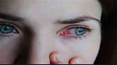 التزم بها.. عناصر غذائية يمكنها حماية العين من الآثار الضارة في الصيف