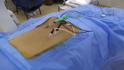 وحدة علاج الألم والتخدير بالشرقية تقدم خدمات طبية متقدمة لحالتين بدون تدخل جراحى