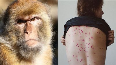 هل هناك حالات مصابة بفيروس جدري القرود في مصر.. الصحة تُجيب