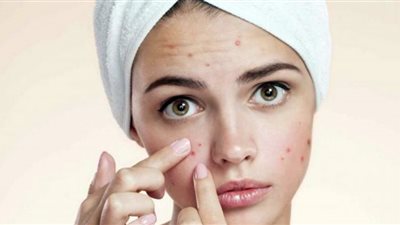 نوعان من الأطعمة يسببان حب الشباب