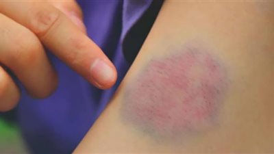 مواد غذائية تزيد من خطر الإصابة بتجلطات الدم