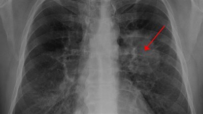 بشرى سارة.. مكملات عشبية تُظهر نتائج واعدة ضد سرطان الرئة