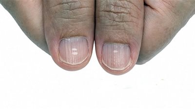 أعراض تفاقم فقر الدم الناجم عن نقص الحديد