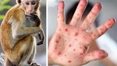 أعراض جدري القرود وكيفية انتقاله وطرق الوقاية منه (فيديوجراف)