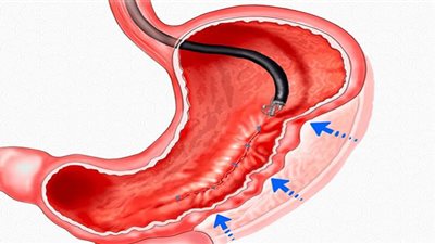 دراسة: فقدان الوزن بالجراحة يقلل مخاطر الإصابة بالسرطان