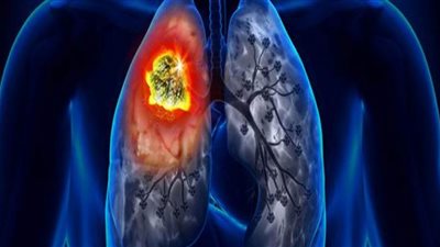 أطباء بريطانيون يكشفون أعراض غير متوقعة لسرطان الرئة