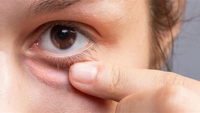 علامة في عينيك تحذر من ارتفاع السكر