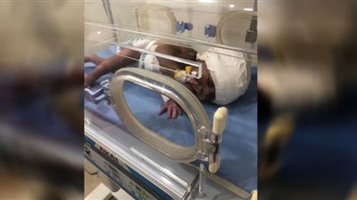 جراحة دقيقة لتركيب صمام بالمخ لطفلة بمركز الإيواء بالعاشر من رمضان