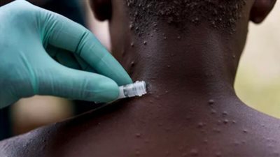 تحذير من السلطات.. مصاب بجدري القرود يهرب من المستشفى