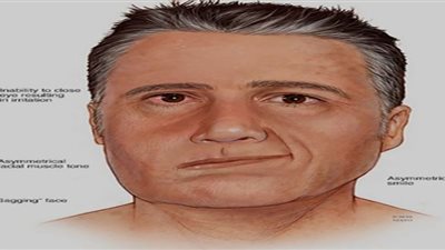 Ramsay Hunt .. بعد إصابة جاستن بيبر بها.. ما متلازمة رامزي هانت