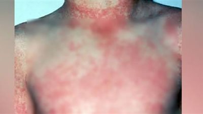 الحمى النزفية فيروس جديد في عصر كورونا.. تلف في الأوعية الدموية وتجلط الدم