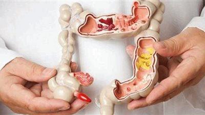 علامات تدل على إصابتك بسرطان الأمعاء